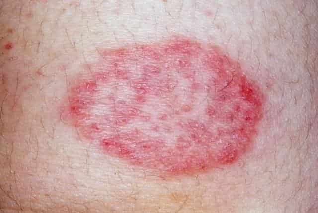 Red Spots on Skin, Patches, Small, Tiny, Pinpoint, Not Itchy, Pictures ...