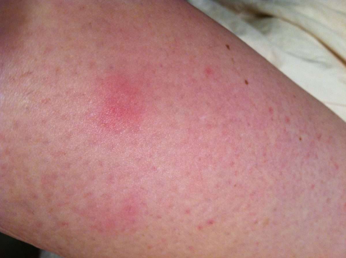 reddish bumps on skin