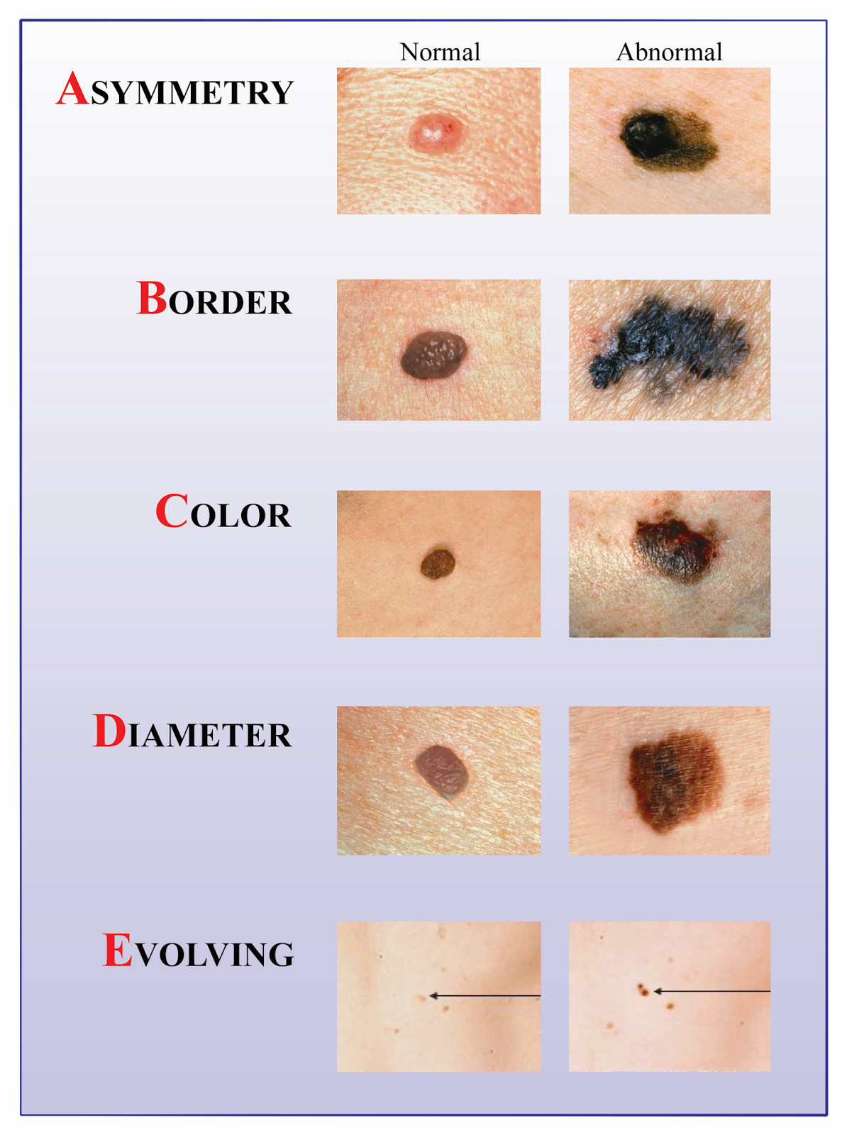 Remember the ABCDEs of Melanoma!