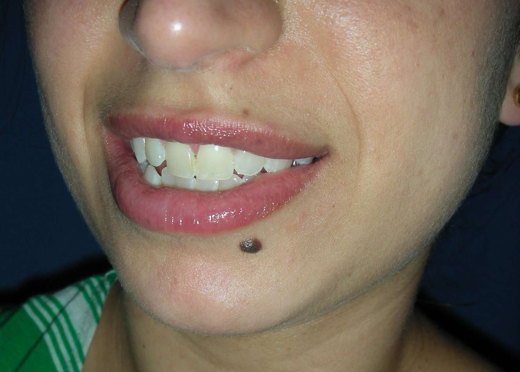 Removal of mole lower lip