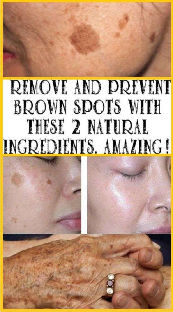 REMOVE AND PREVENT BROWN SPOTS WITH THESE 2 NATURAL INGREDIENTS ...