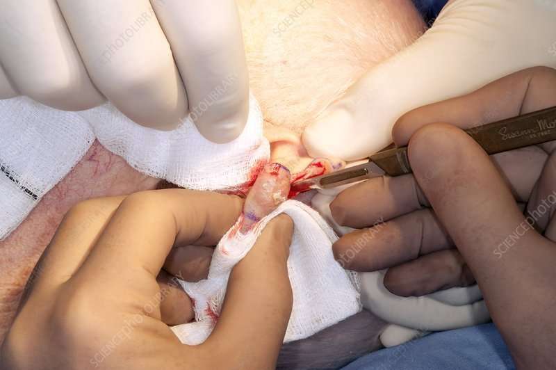 Removing skin cancer from the ear