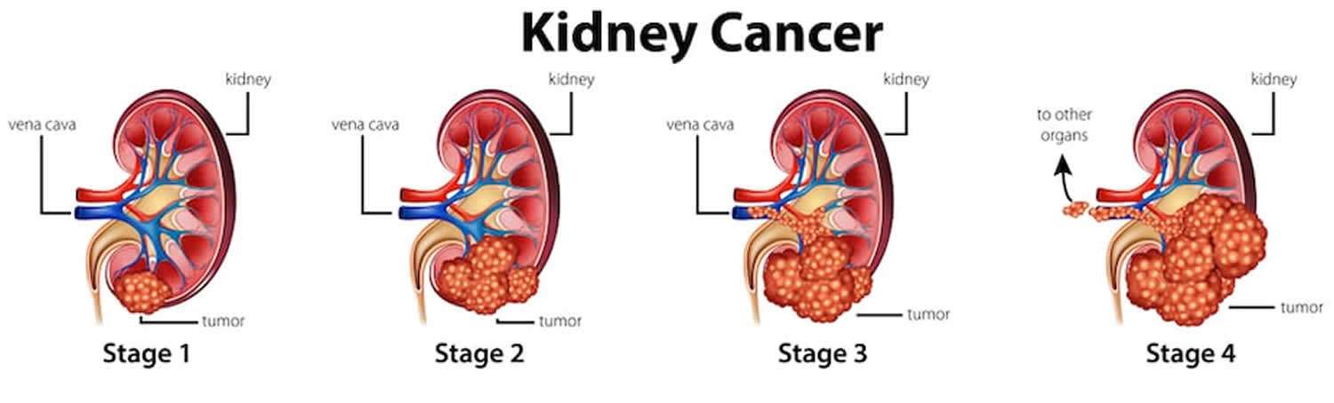 Renal cell carcinoma causes, risk factors, symptoms ...