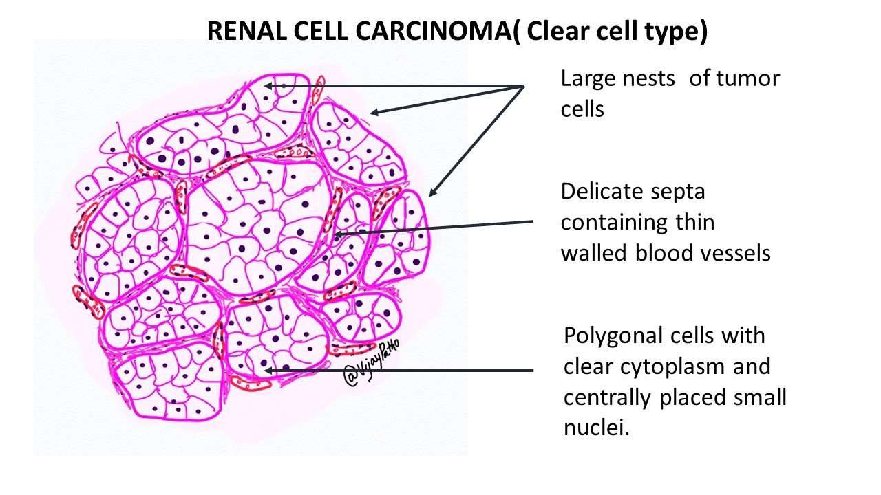 RENAL CELL CARCINOMA