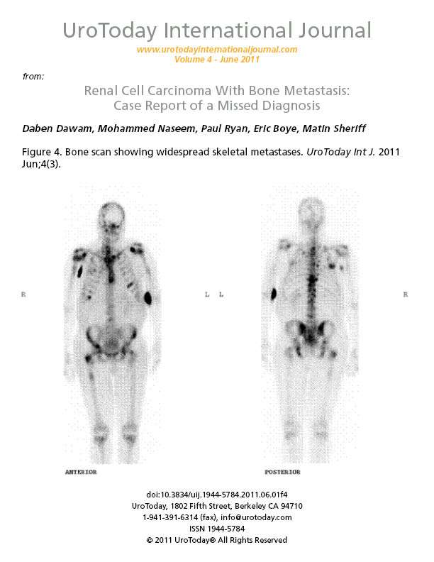 Renal Cell Carcinoma With Bone Metastasis: Case Report of ...