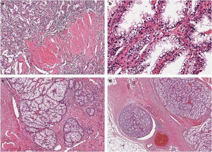 Renal cell tumors with clear cell histology and intact VHL ...