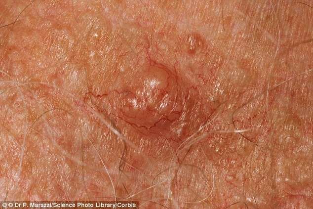 Revealed... how to tell if you have skin cancer: From ...
