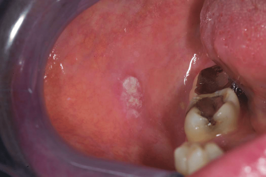 Right buccal mucosa squamous cell carcinoma (case 3 ...