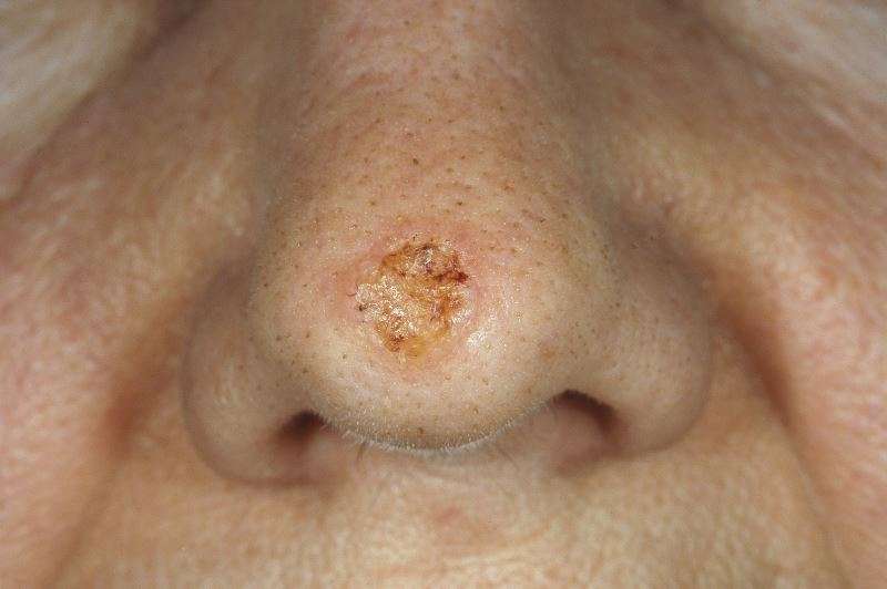 Risk for Basal, Squamous Cell Carcinoma Linked to ...