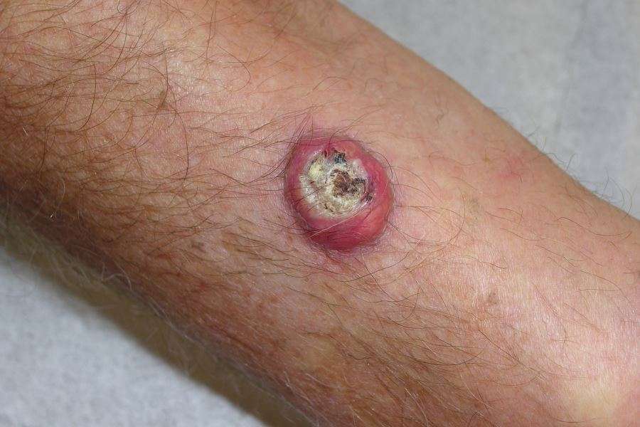 Risk for Cutaneous Squamous Cell Carcinoma Increased With ...