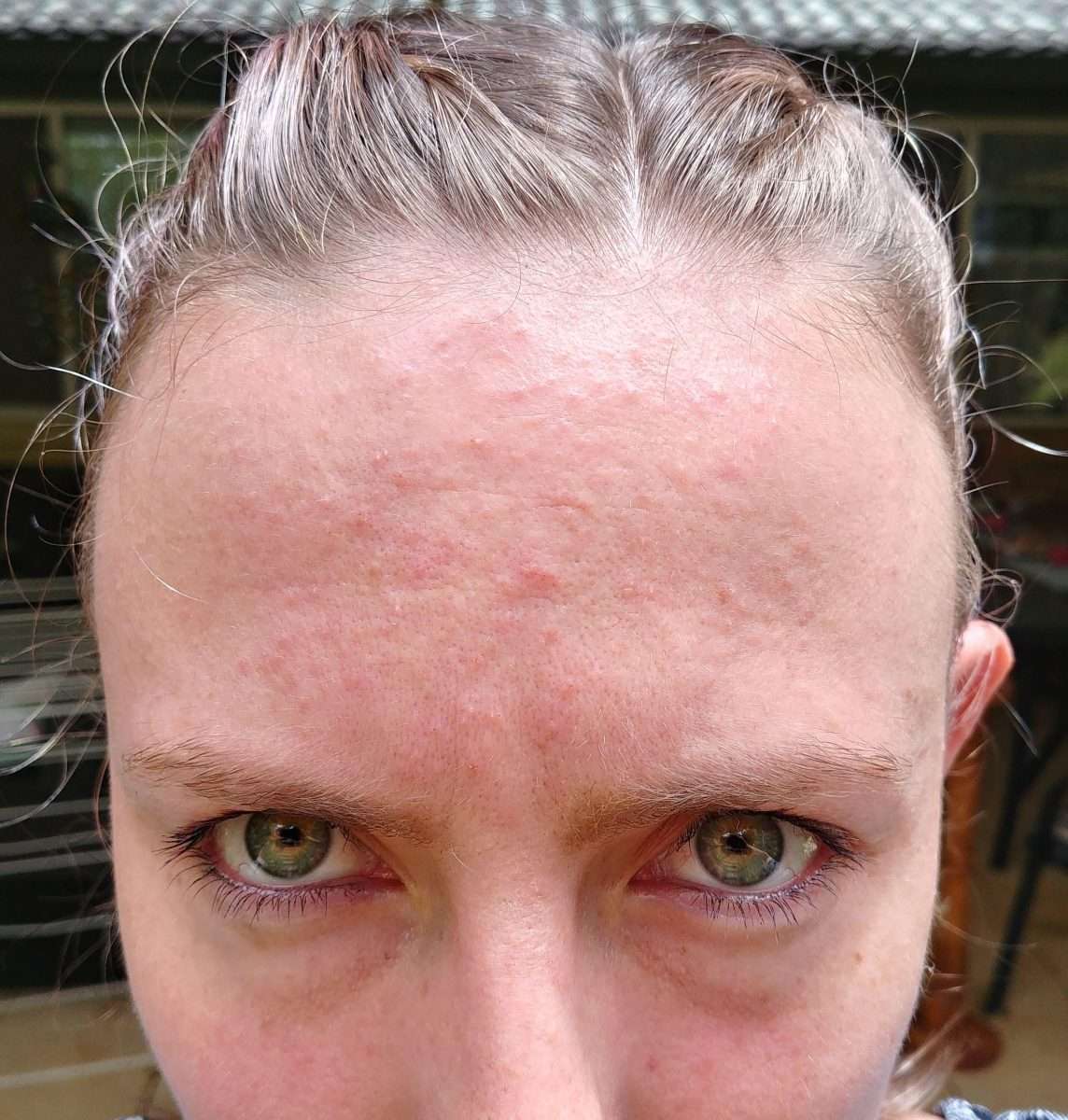 [Routine HELP] Face breaking out in small bumps (pimples?) which have ...