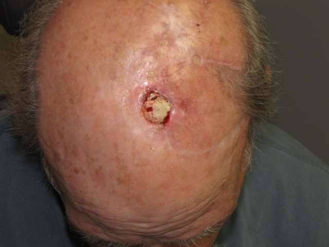 Scalp Radiation for High Risk Skin Cancer  The Perils and ...