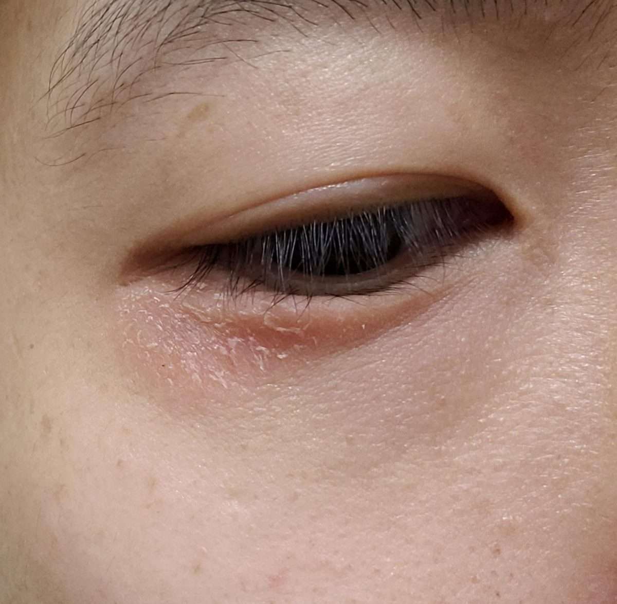 Scaly and Dry Skin with Redness on Corner of Eye. Anyone know what it ...