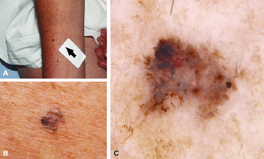 Set of images of pigmented basal cell carcinoma: clinical ...