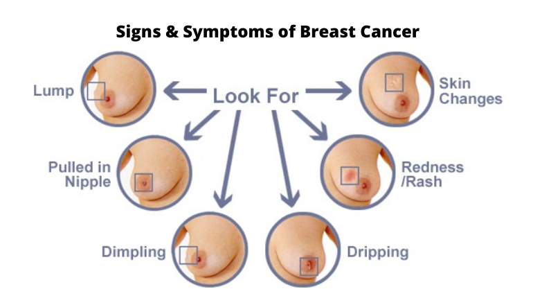 Signs and Symptoms of Breast Cancer
