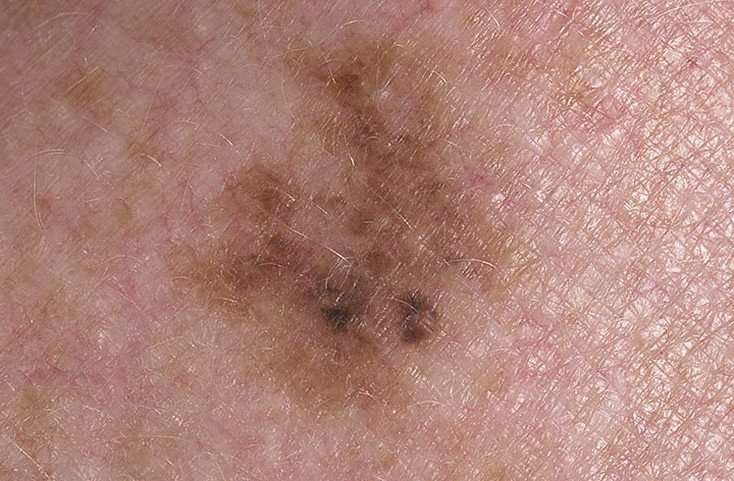 Signs of Melanoma Pictures  27 Photos &  Images ...
