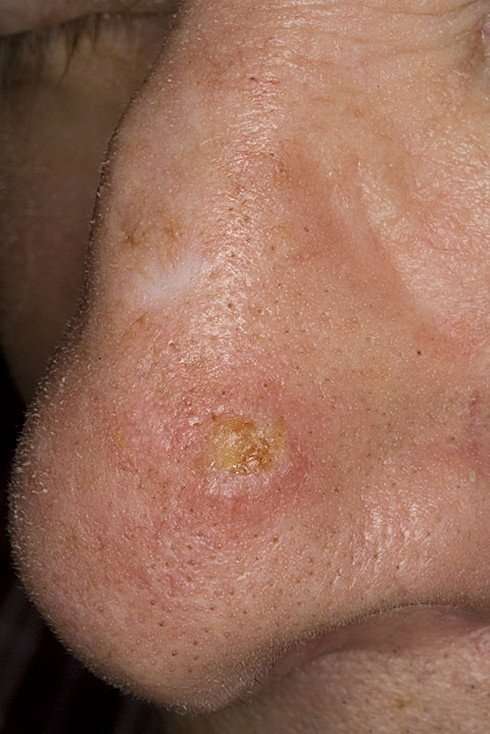 Signs of Skin Cancer Pictures  48 Photos &  Images ...