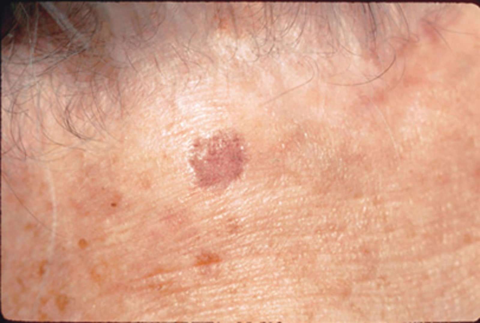 Signs of Skin Cancer: This Skin Check Can Save Your Life ...