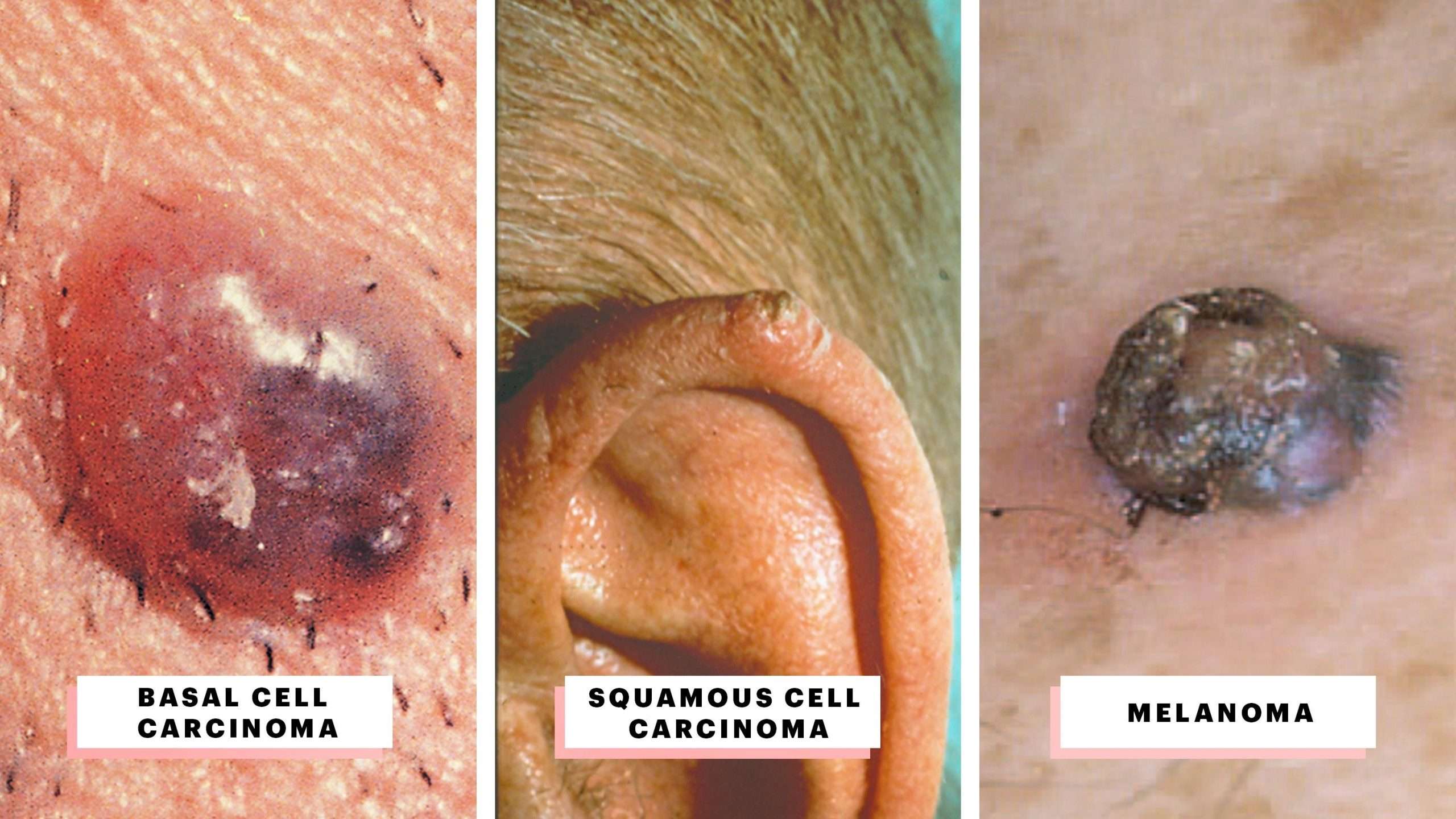 Skin Cancer: A Visual Guide to Identifying Warning Signs ...