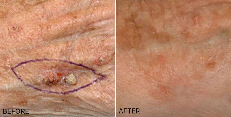 Skin Cancer and Melanoma Reconstruction and Removal