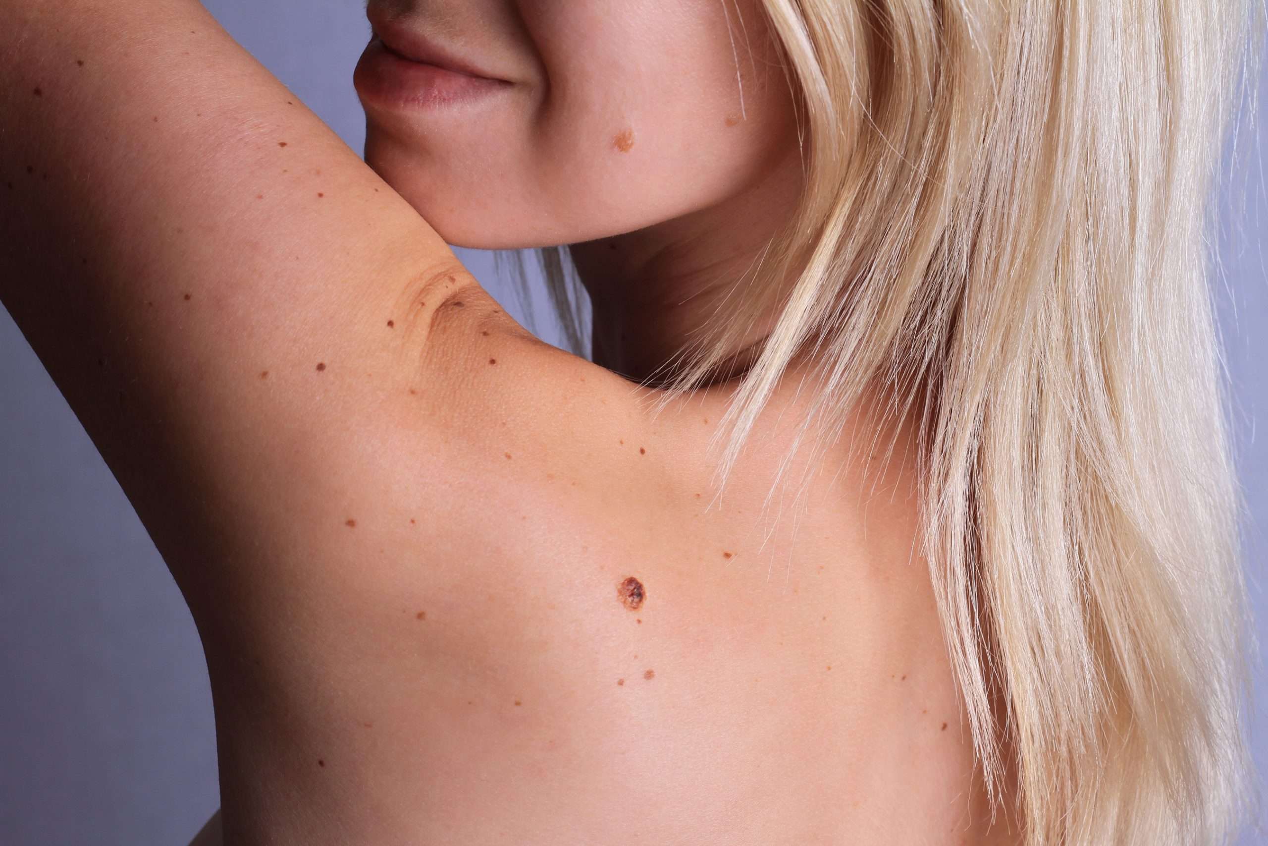 Skin cancer and melanoma