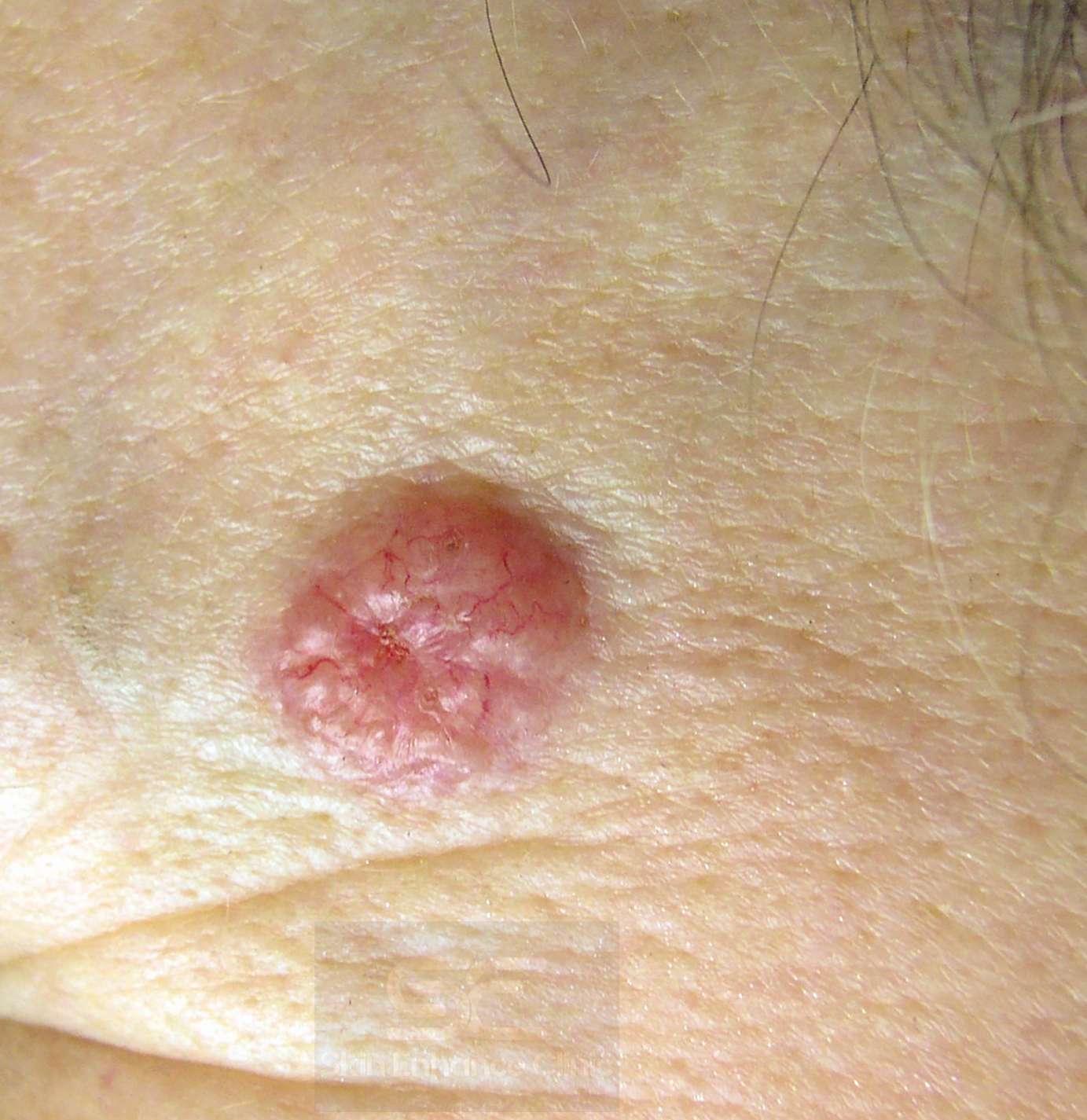 Skin Cancer and Precancerous Skin Lesions: What you need to know