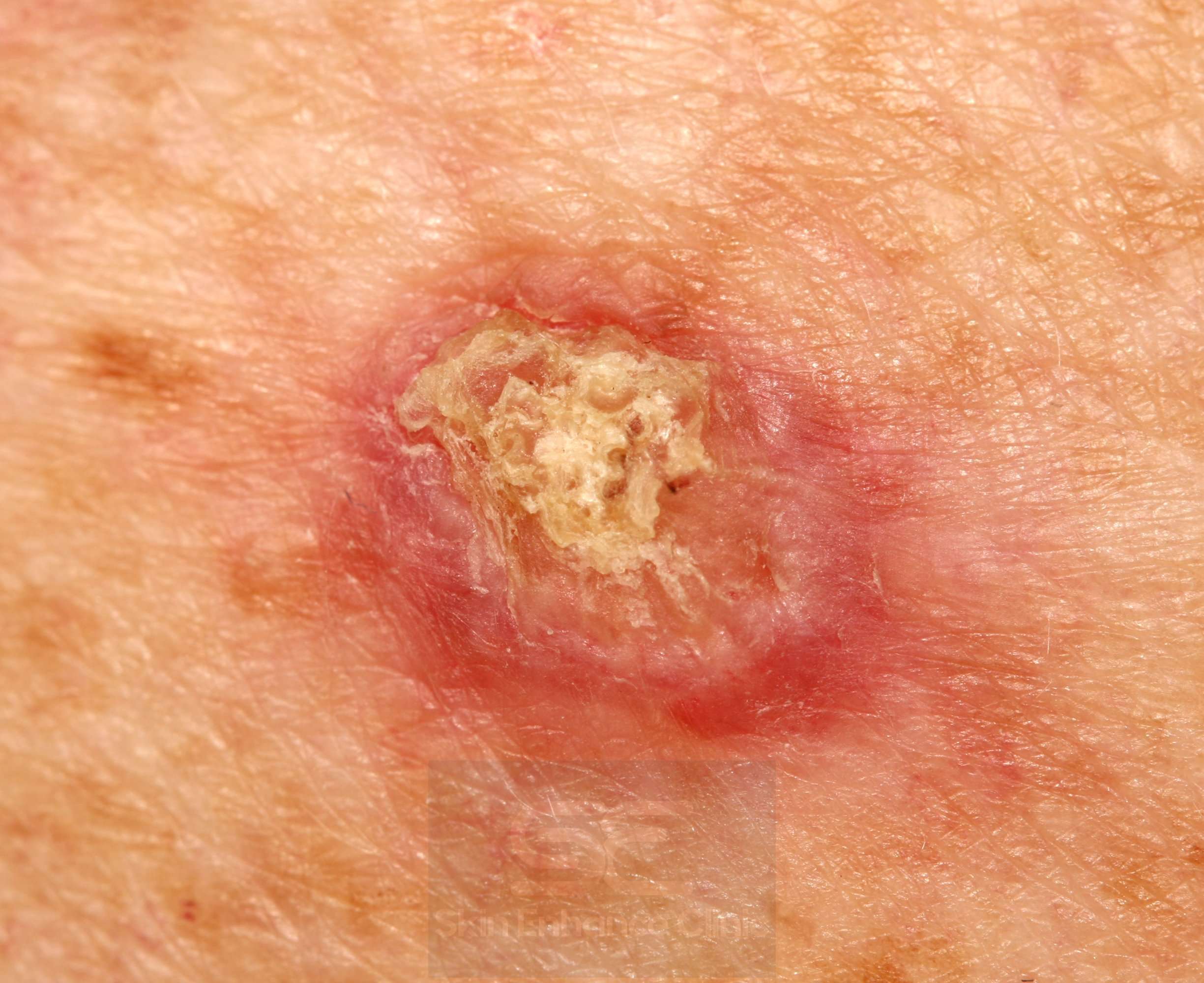 Skin Cancer and Precancerous Skin Lesions: What you need ...