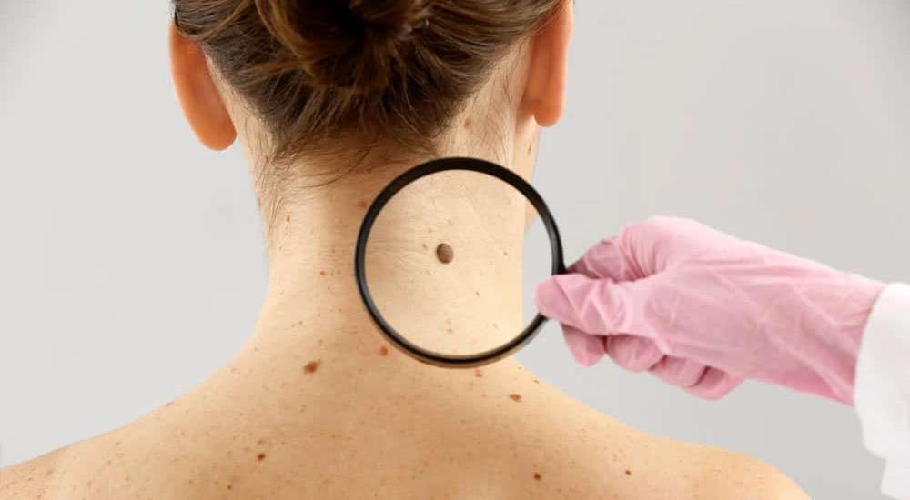 Skin Cancer: Causes, Symptoms, Diagnosis and Treatment