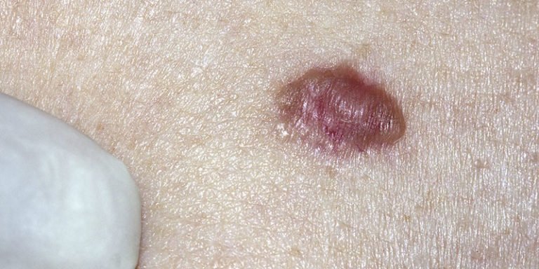 Skin Cancer Diagnosis and Removal