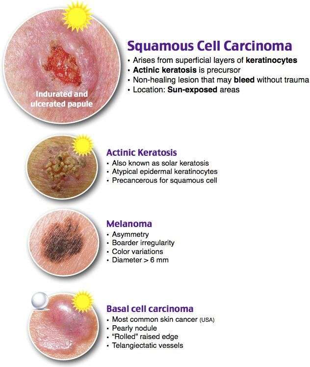 Skin Cancer ~ Health Care Solutions
