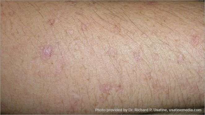 Skin Cancer Images On Arm