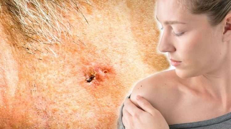Skin cancer: Main symptoms to look out for warning of ...