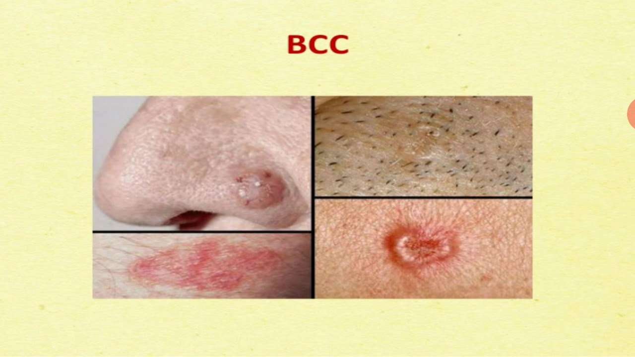 skin cancer &  malignant melanoma