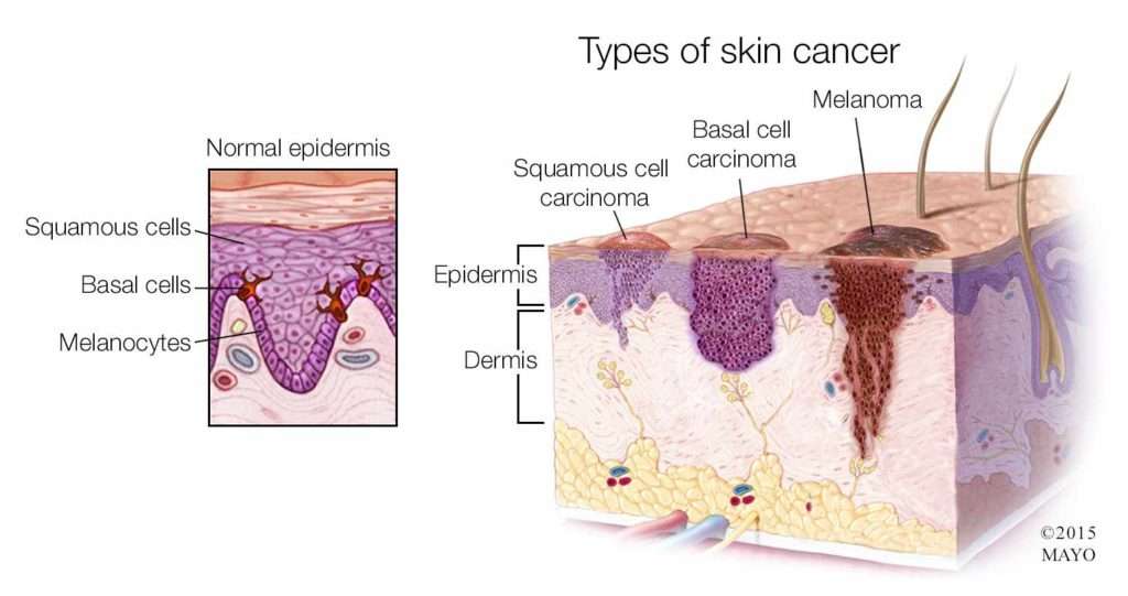 Skin Cancer &  Melanoma: Causes, Symptoms, Treatment ...