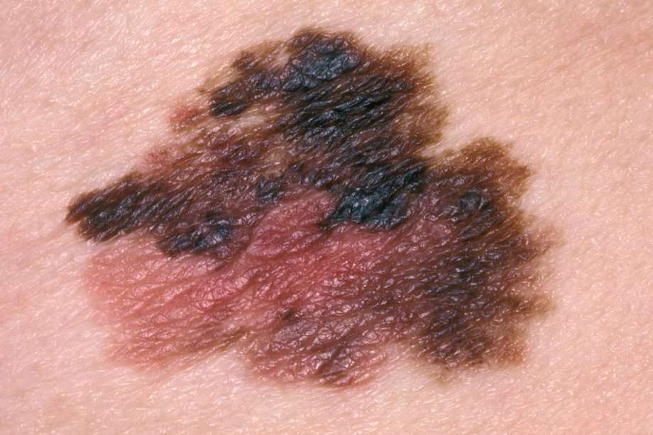 Skin cancer (melanoma)