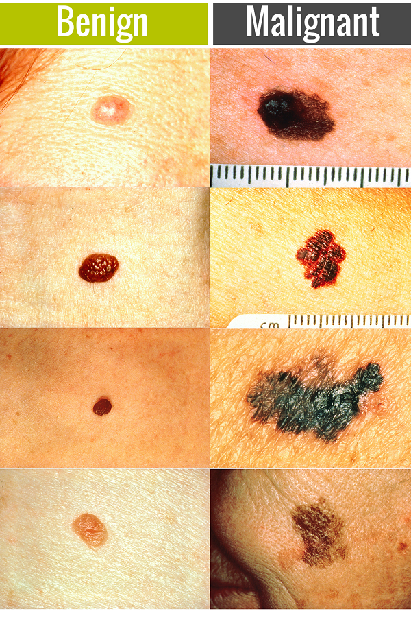 Skin Cancer Misdiagnosis Claims