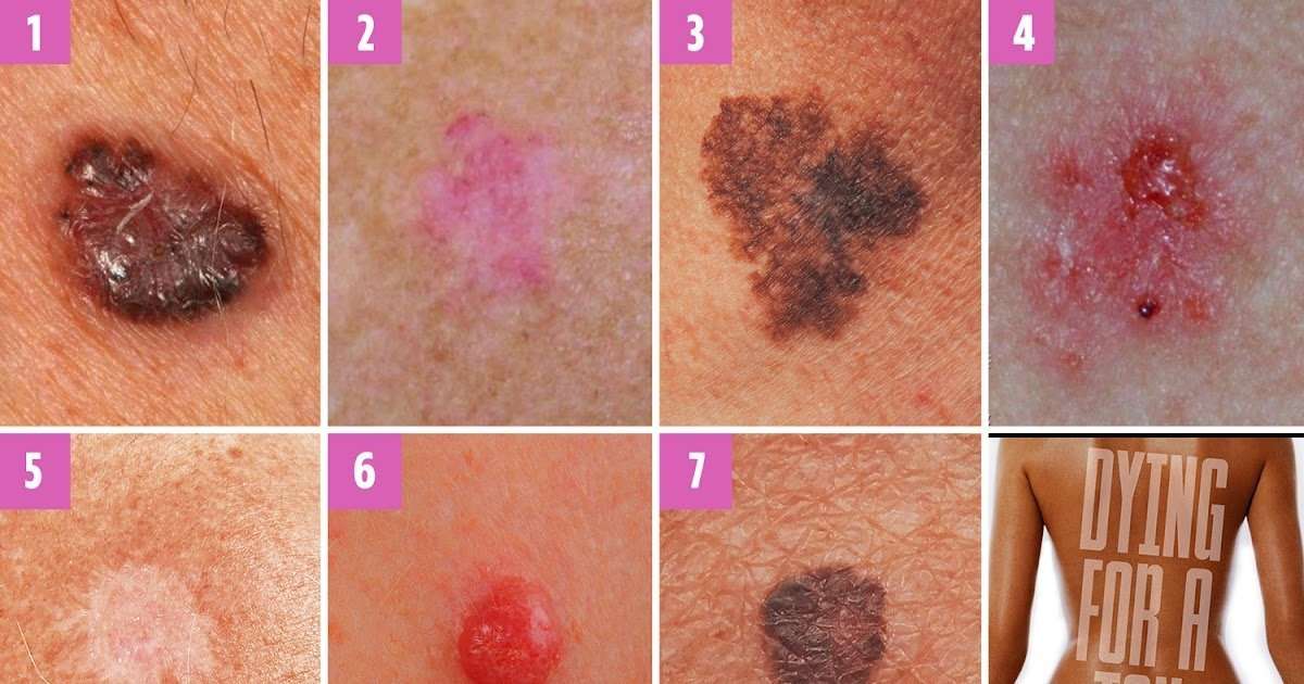 Skin Cancer Mole