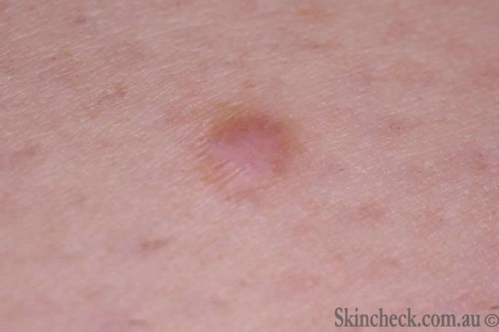 Skin Cancer Moles On Legs