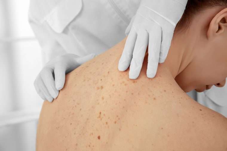 Skin Cancer Myths You Need to Stop Believing