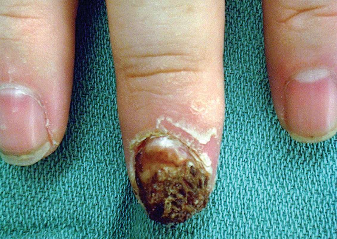 Skin Cancer of the hand and upper extremity