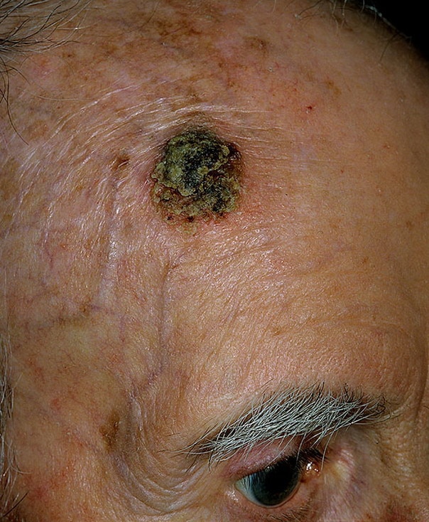 Skin Cancer on Face Pictures  33 Photos &  Images / illnessee.com