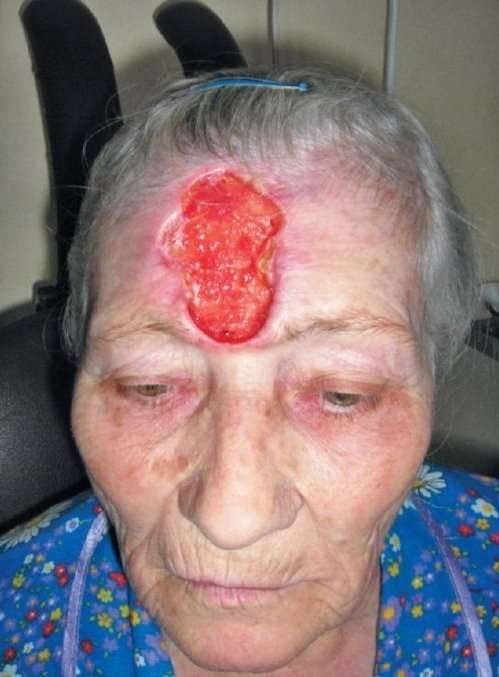 Skin Cancer on Face Pictures  33 Photos &  Images ...