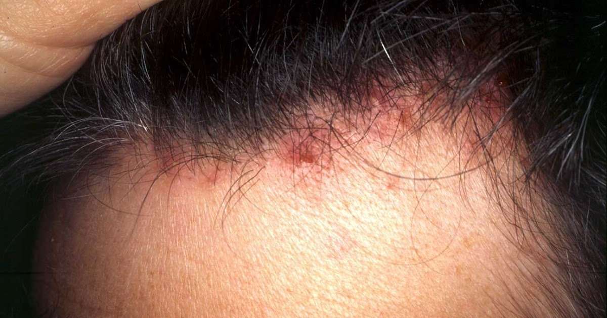 Skin Cancer On Scalp Itchy