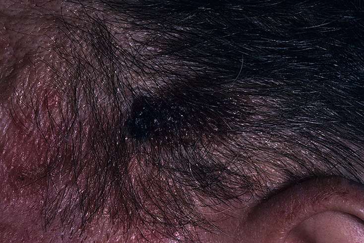 Skin Cancer on Scalp Pictures  20 Photos &  Images / illnessee.com