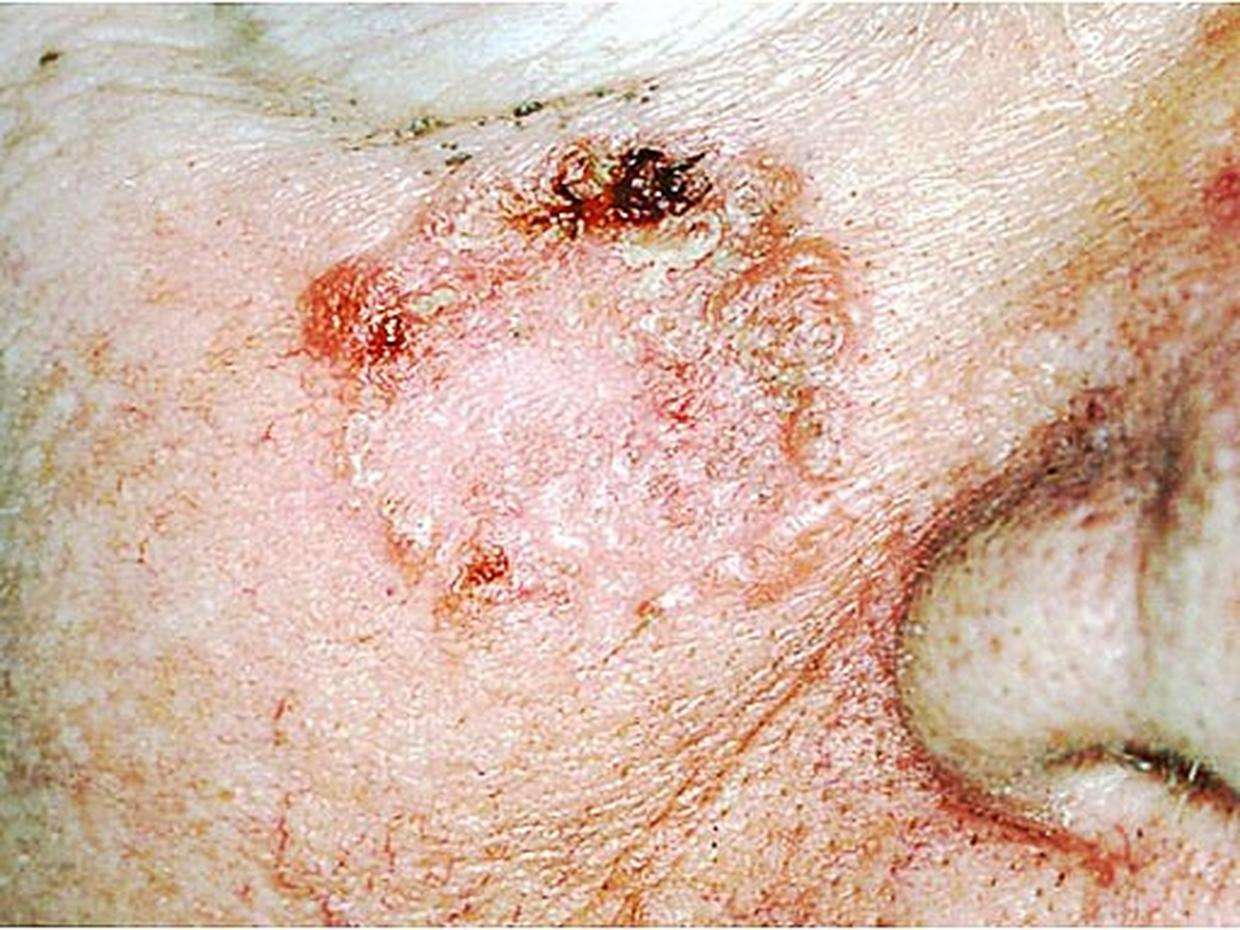 Skin cancer or mole? How to tell