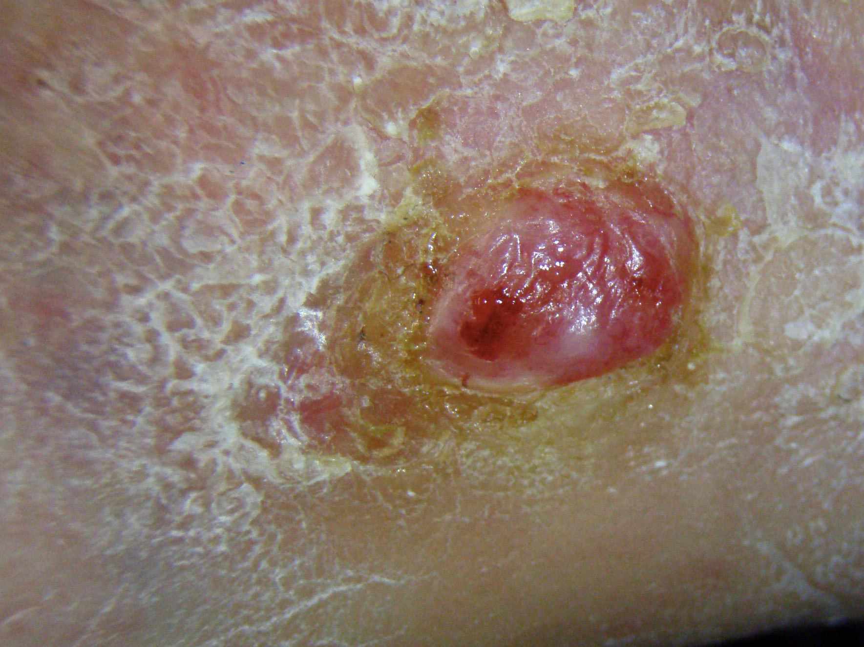 Skin Cancer: Overview and More