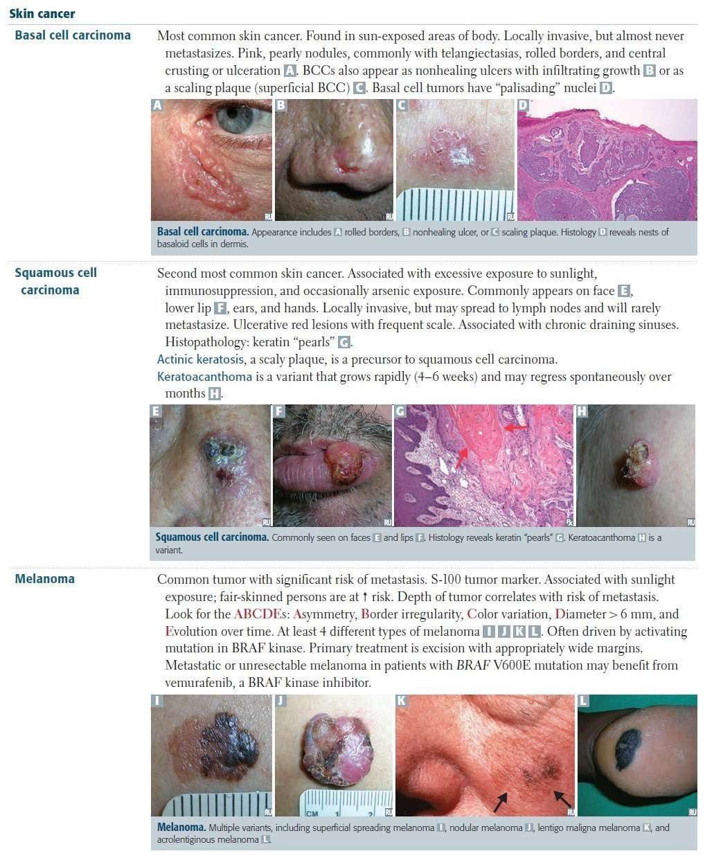 Skin Cancer Overview