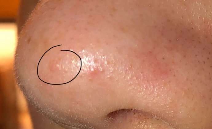 Skin cancer?? plz help