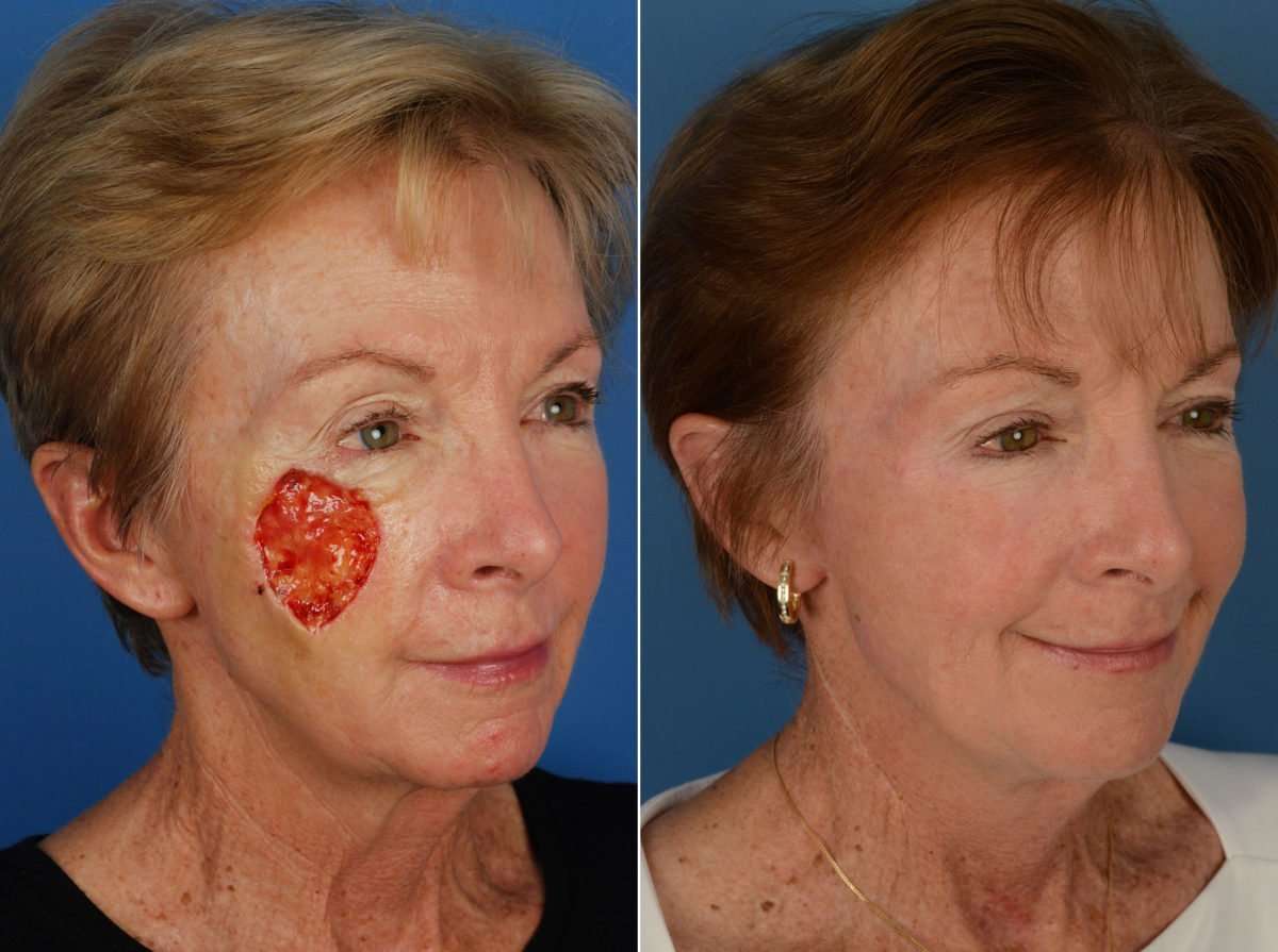 Skin Cancer Reconstruction Photos