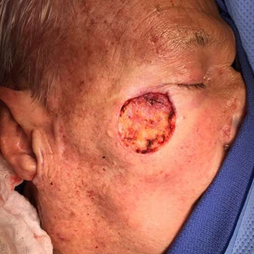 Skin Cancer Repair Case 1237